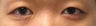 Bilateral Asian Eyelid Surgery