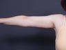 49 year old with sagging arm skin