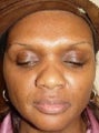 Sculptra to Smile Lines