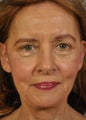 Upper and Lower Blepharoplasty