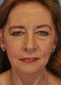Upper and Lower Blepharoplasty