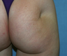 Fat transfer