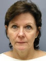 SMAS Facelift, LiteLift, Mini Lift