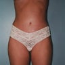 Liposuction