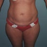 Liposuction