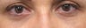 Bilateral Lower Blepharoplasty