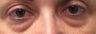 Bilateral Lower Blepharoplasty