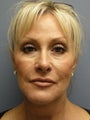 Neck Lift on 64-year-old