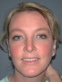 Otoplasty, Ear Surgery