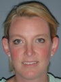 Otoplasty, Ear Surgery