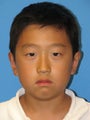Otoplasty Ear Surgery - Boy