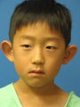 Otoplasty Ear Surgery - Boy