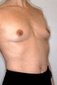 Breast Augmentation