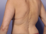 Zeltiq CoolSculpting