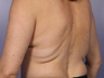 Zeltiq CoolSculpting