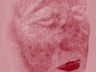 Rosacea treated with IPL treatments