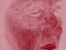 Rosacea treated with IPL treatments
