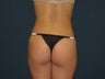 Liposuction with Fat Transfer to buttocks