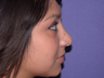 Rhinoplasty