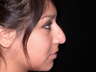 Rhinoplasty