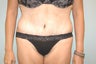 35 Year Old Female for post Massive Weight Loss 