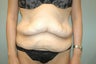 35 Year Old Female for post Massive Weight Loss 