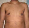 Male Breast Reduction