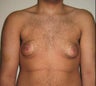 Male Breast Reduction