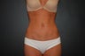 SMall volume liposculpting / liposuction