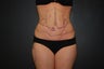 SMall volume liposculpting / liposuction
