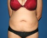 Abdominoplasty