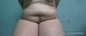 Tummy Tuck