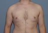 Liposuction of the male chest
