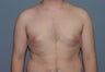 Liposuction of the male chest