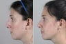 Rhinoplasty