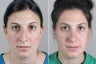 Rhinoplasty