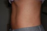 CoolSculpting Treatment of Abdomen