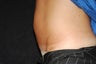 CoolSculpting Treatment of Abdomen