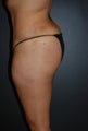 35 year old mom wnating more fullness of her buttocks.