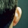 Otoplasty 