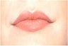 Lip Augmention