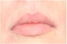 Lip Augmention