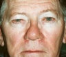 Blepharoplasty