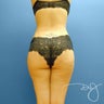 Brazilian Butt Lift