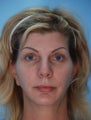 Upper and Lower Blepharoplasty