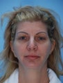 Upper and Lower Blepharoplasty
