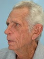 Facial Reconstruction