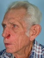 Facial Reconstruction
