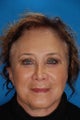 Upper and Lower Blepharoplasty
