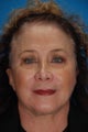 Upper and Lower Blepharoplasty
